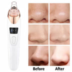 Upgraded Blackhead Remover Vacuum – Facial Pore Cleaner & Whitehead Extractor Tool